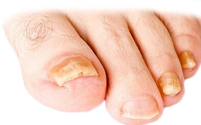 nail gombák a lábszár kezeléssel népi gyógyászatban