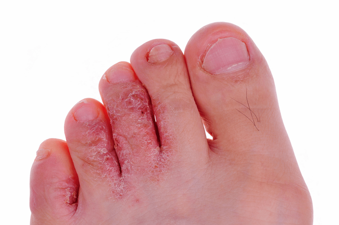 a lábujjak közötti bőr gombás fertőzése