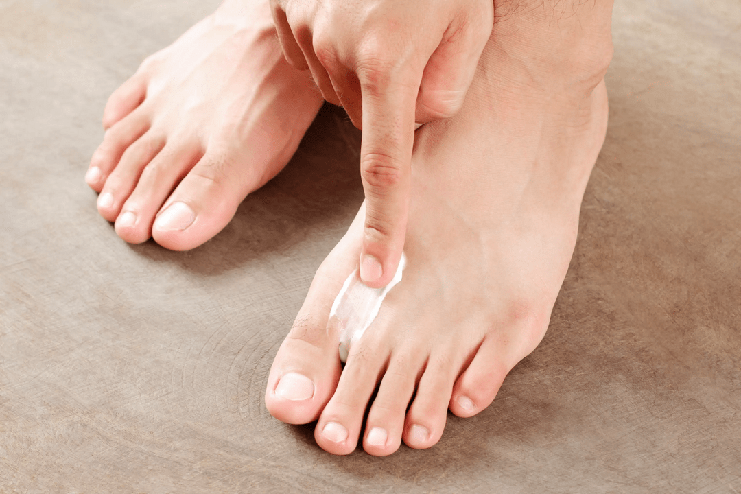 gombaellenes kenőcs felvitele a láb bőrére