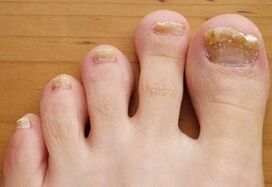 Futtatott onchomycosis