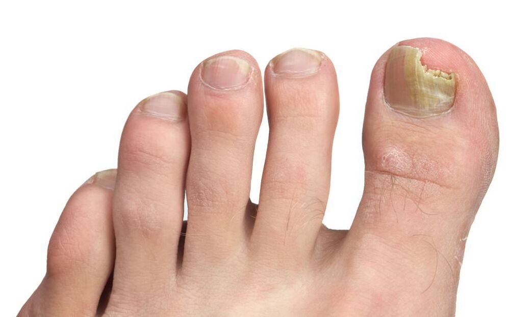 Onchomycosis