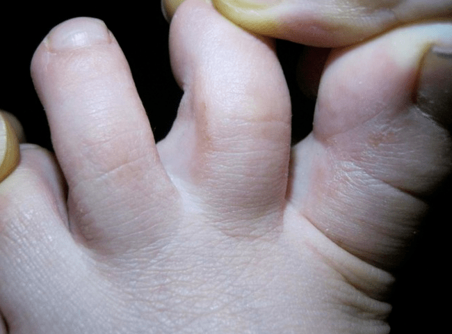 Mycosis gyermekeknél