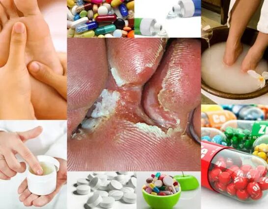 Interdigitális mycosis és kezelési módszerek